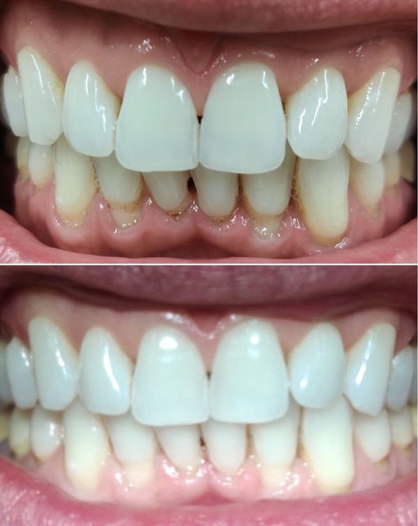 Vor / nach professioneller Zahnreinigung